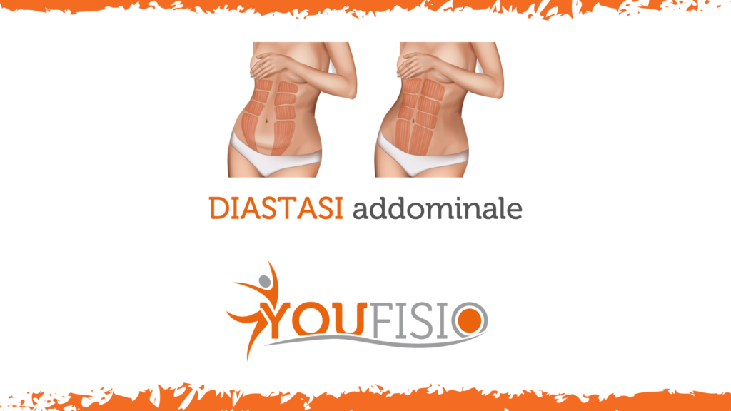 Diastasi Addominale